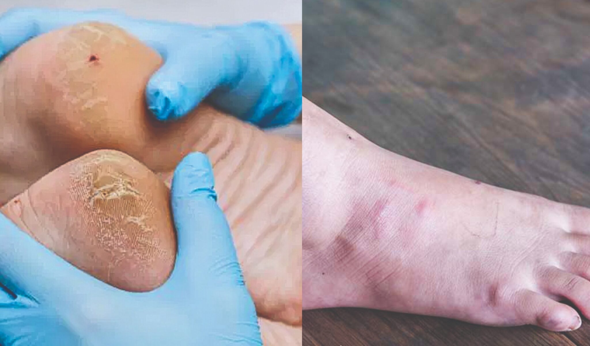Ulser kaki diabetes luka yang membawa mati - Kosmo Digital