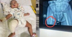Pengasuh pulas paha bayi sampai patah