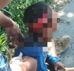 Kanak-kanak lelaki parah diserang anjing liar