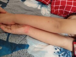 HFMD ‘mengganas’ di Lipis