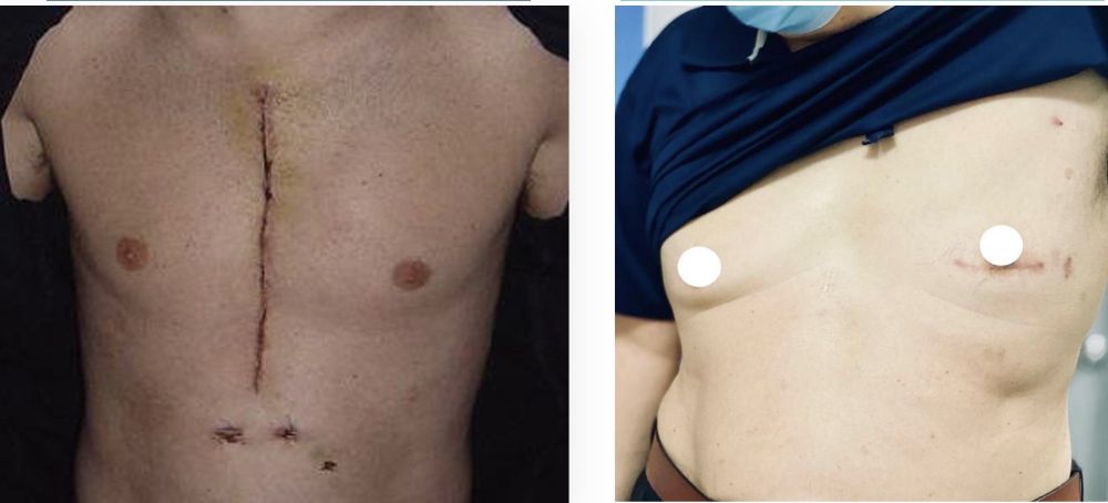 Pembedahan jantung MICS cepat sembuh kerana luka lebih kecil