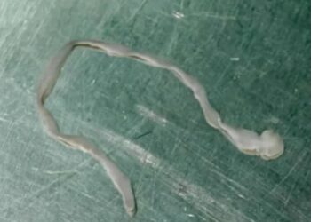 Cacing panjang 8 sentimeter berenang dalam otak wanita